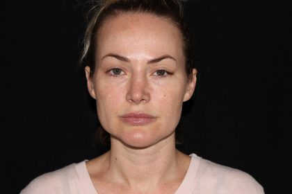 Eye Tyte Before & After Patient #862