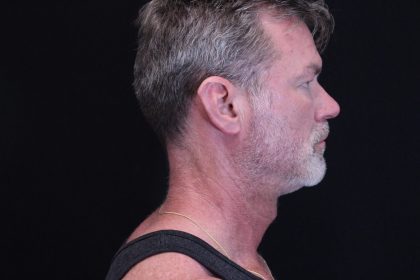 Trifecta Before & After Patient #1007