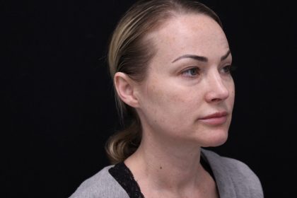 Eye Tyte Before & After Patient #862