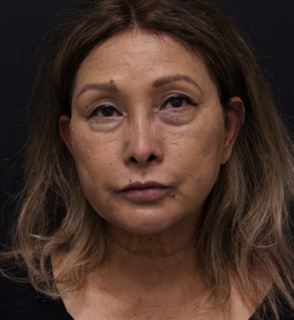 Eye Tyte Before & After Patient #867