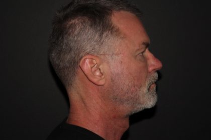 Trifecta Before & After Patient #1007