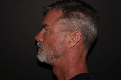 Trifecta Before & After Patient #1007