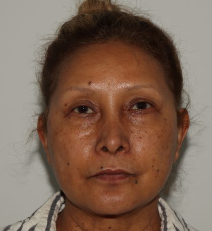 Eye Tyte Before & After Patient #867