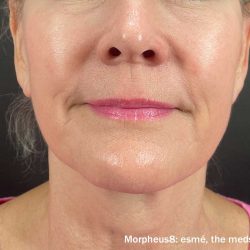 Morpheus Before & After Patient #912