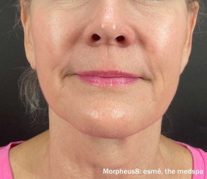 Morpheus Before & After Patient #912