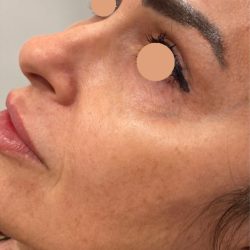 CoolPeel Before & After Patient #844
