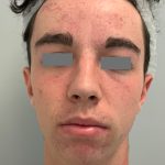 V-Beam Before & After Patient #1008