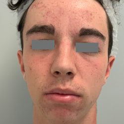 V-Beam Before & After Patient #1008