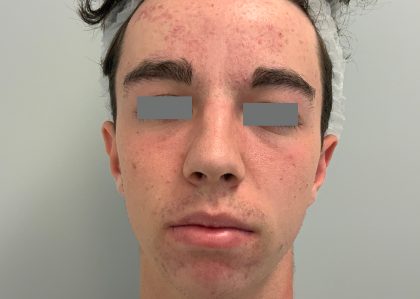 V Beam Before & After Patient #1008