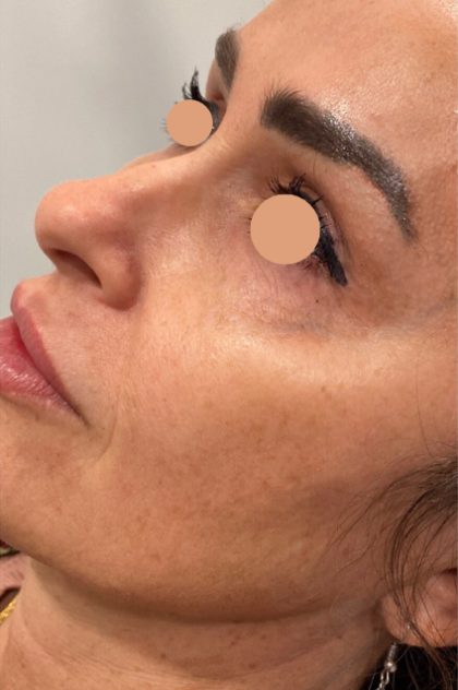 CoolPeel Before & After Patient #844