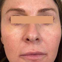 CoolPeel Before & After Patient #861