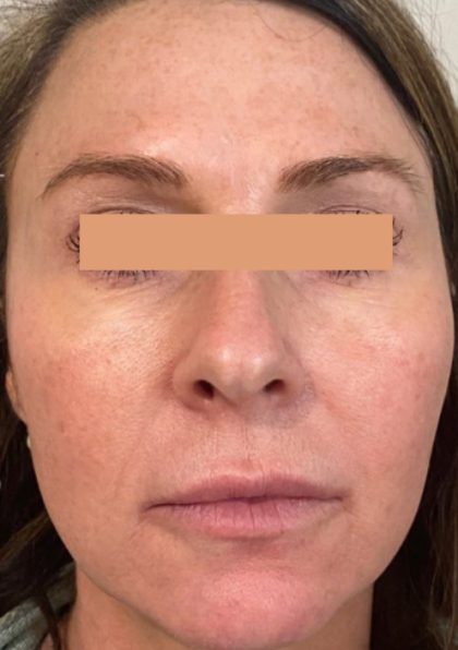 CoolPeel Before & After Patient #861