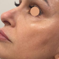 CoolPeel Before & After Patient #844