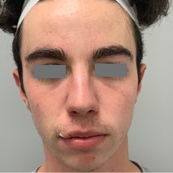 V-Beam Before & After Patient #1008