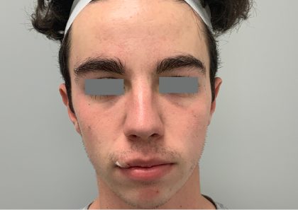 V Beam Before & After Patient #1008