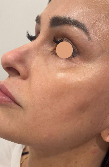 CoolPeel Before & After Patient #844