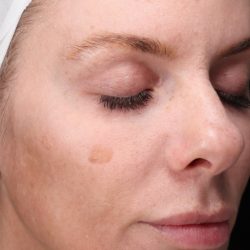 CoolPeel Before & After Patient #857