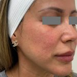 V-Beam Before & After Patient #1011