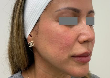 V-Beam Before & After Patient #1011