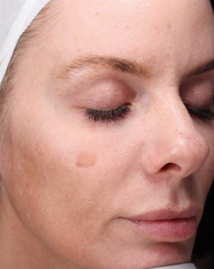 CoolPeel Before & After Patient #857
