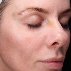 CoolPeel Before & After Patient #857