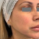 V-Beam Before & After Patient #1011