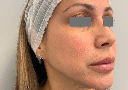 V-Beam Before & After Patient #1011