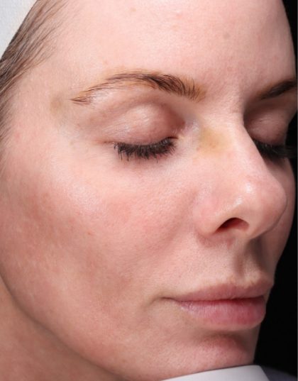 CoolPeel Before & After Patient #857