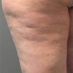 Profound Before & After Patient #948