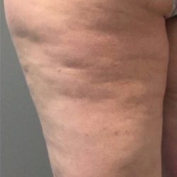 Profound Before & After Patient #948