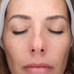 CoolPeel Before & After Patient #858