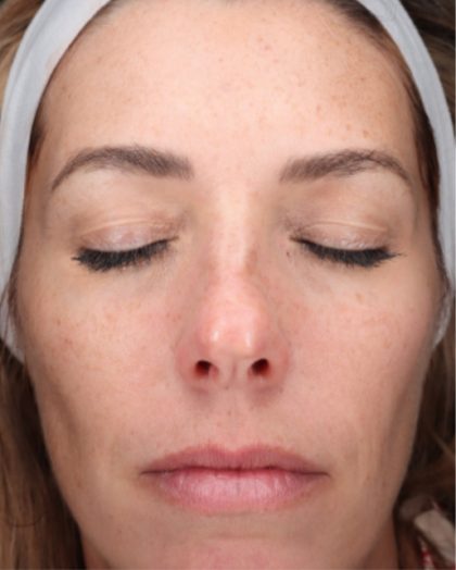 CoolPeel Before & After Patient #858
