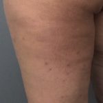 Profound Before & After Patient #948
