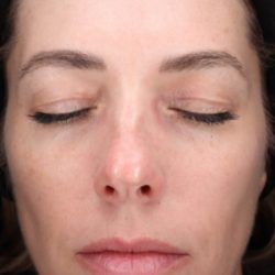 CoolPeel Before & After Patient #858