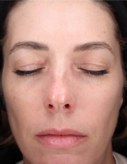 CoolPeel Before & After Patient #858