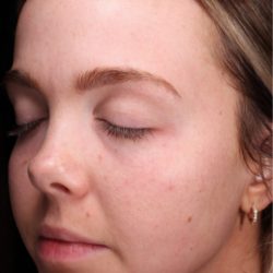 CoolPeel Before & After Patient #859