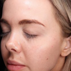 CoolPeel Before & After Patient #859