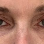 Tetra Pro Co2 Before & After Patient #971