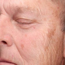 CoolPeel Before & After Patient #860