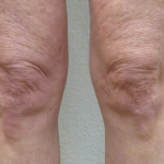 Morpheus Before & After Patient #910