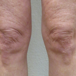 Morpheus Before & After Patient #910