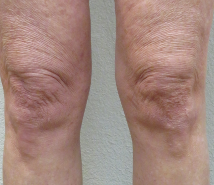 Morpheus Before & After Patient #910