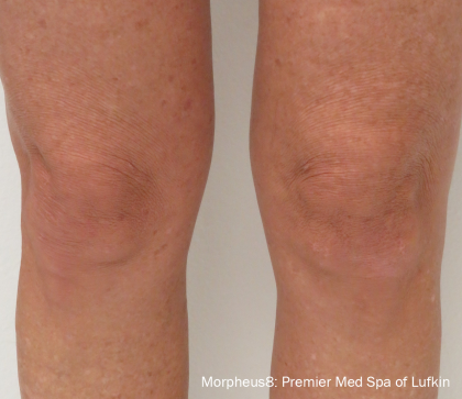 Morpheus Before & After Patient #910