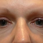 Morpheus Before & After Patient #937