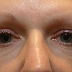 Morpheus Before & After Patient #937