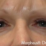 Morpheus Before & After Patient #937