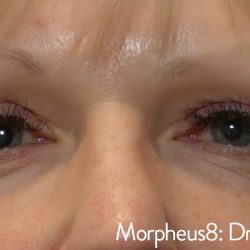 Morpheus Before & After Patient #937
