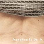 Morpheus Before & After Patient #904