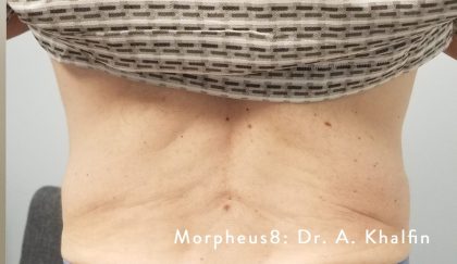 Morpheus Before & After Patient #904