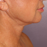 Morpheus Before & After Patient #938